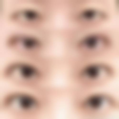 七、做完双眼皮疤痕修复的费用为何差异明显？价格区间如何形成？