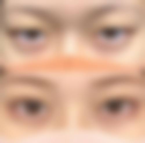 十一、在决定埋线双眼皮前，普通用户更容易忽略的关键信息