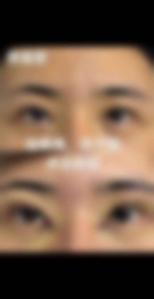 二、埋线双眼皮通常在什么阶段被纳入医疗选择范围？