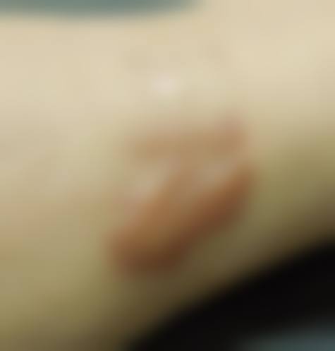 为什么离子束治疗疤痕的前后对比差异会非常明显