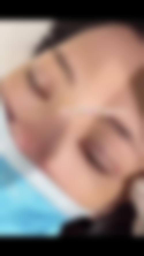 医院医生怎么选？保护非手术双眼皮成效