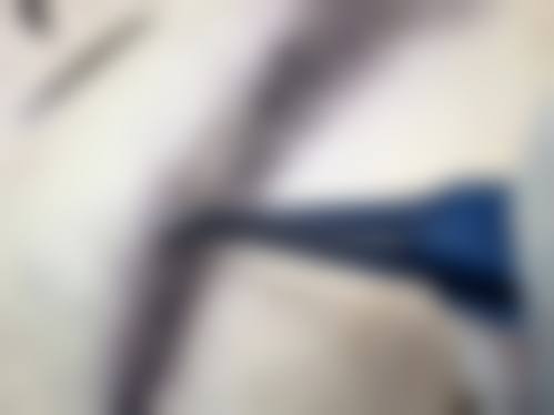 九、围绕疤痕体质纹眉，临床中更常见的并发问题有哪些？