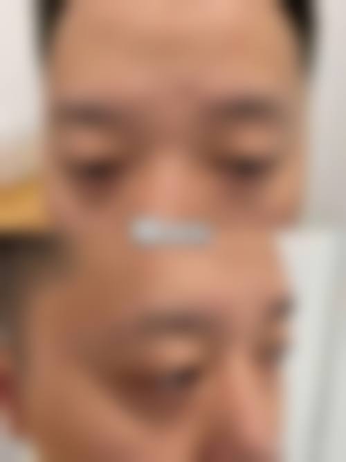 六、疤痕体质纹眉所依赖的技术 / 材料，现实优势与限制并存