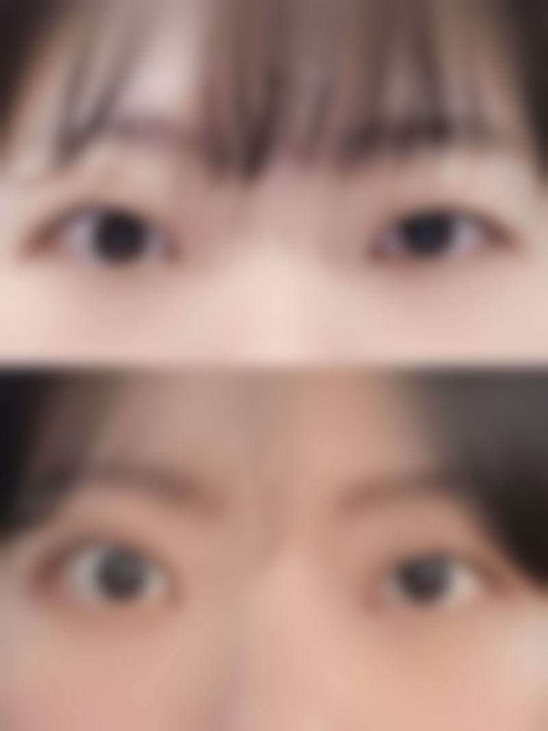 五、在实际操作中，埋线双眼皮更适合哪些人？