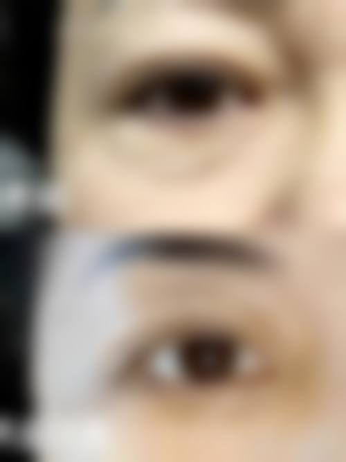 双眼皮修复手术价格区间及费用差异来源