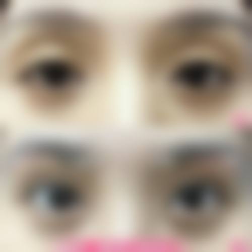 双眼皮修复手术是什么？在什么情况下会被选择？