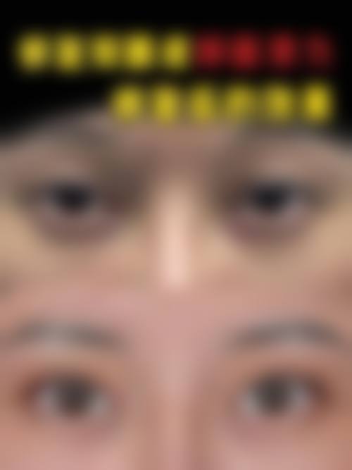 纳米无痕双眼皮价格区间及费用差异来源