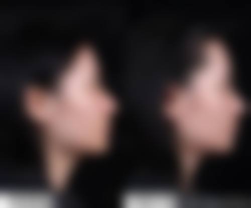 隆鼻医院选择要点：擦亮双眼选对地方