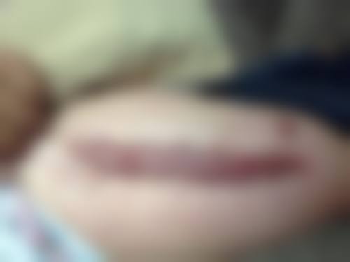 激光药物压力疗法改善增生疤痕的原理是什么？