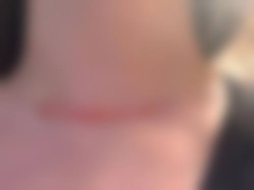 放射疗法修复疤痕增生的优缺点