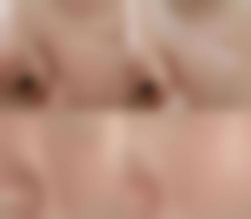 {儿童凹陷疤痕可以点阵激光治疗吗？可以！疗效显著、安全性高且副作用少，家长别错过！点阵激光祛疤效果好，费用几百到数千不等 