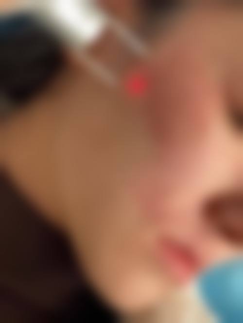 点阵激光治疗儿童凹陷疤痕的费用是多少？价格范围早知道！