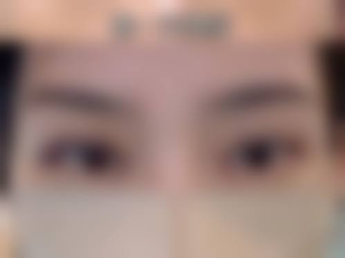 内双做双眼皮手术成效好不好