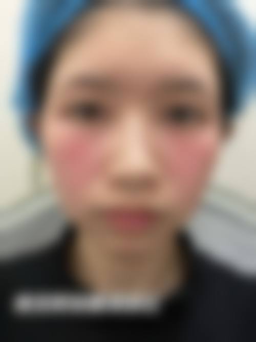 祛眼袋手术成效能维持多久?