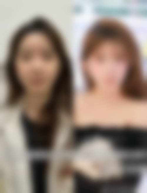 {隆鼻需要注意什么？术前选好医院医生、术后做好护理恢复，这些要点一个不能少！｜含选院要点+7k-6w隆鼻价目