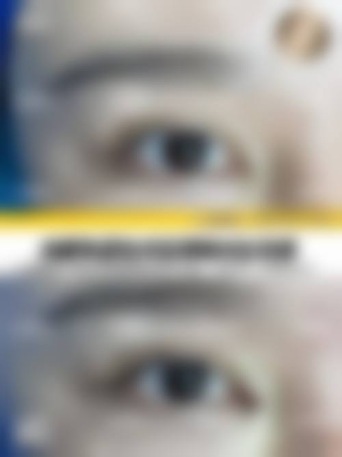 哪些使用场景下双眼皮开眼角的成效往往不理想