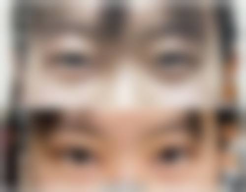 纳米无痕双眼皮是什么?在什么情况下会被选择?