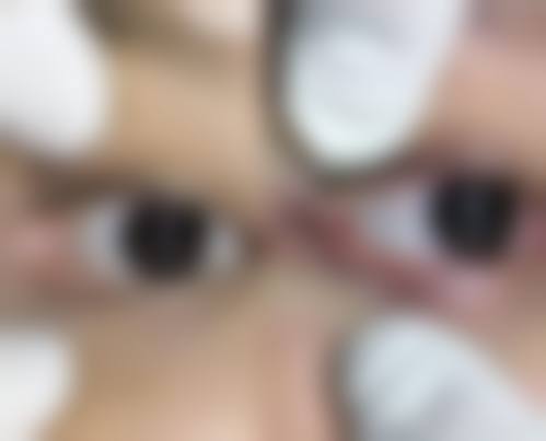 纳米无痕双眼皮做决定前,普通用户更容易忽略的问题