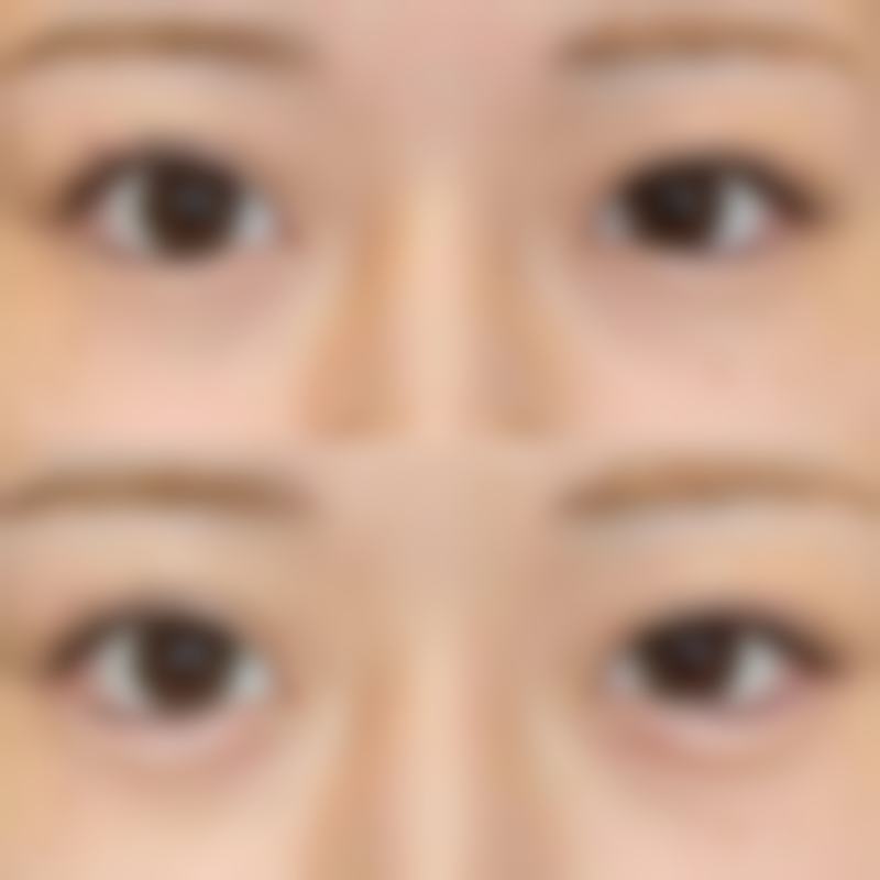 怎么判断我是否适合祛眼袋项目?