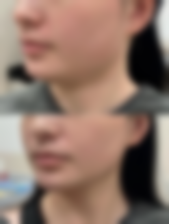 隆鼻术前选医院医生：开启美丽的关键一步