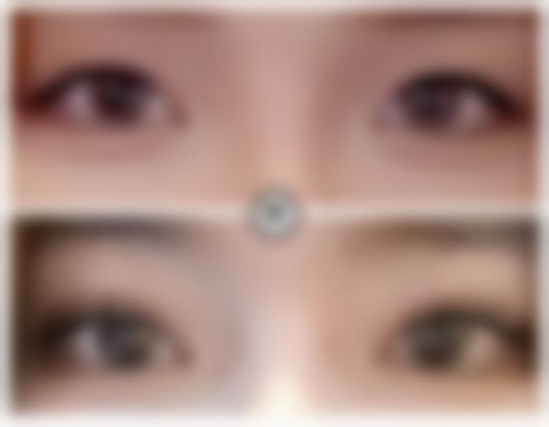 双眼皮修复手术是否危险？风险主要集中在哪些环节？