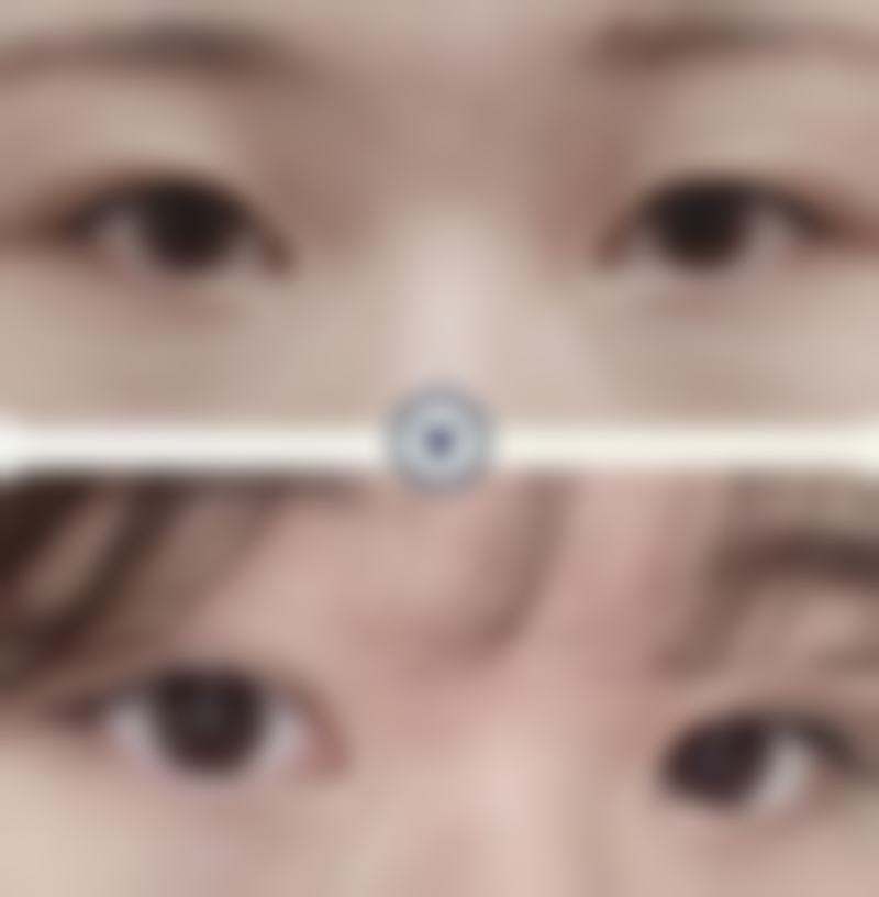 如何为减肥使单眼皮变双眼皮设定一个合理且可验证的成效目标