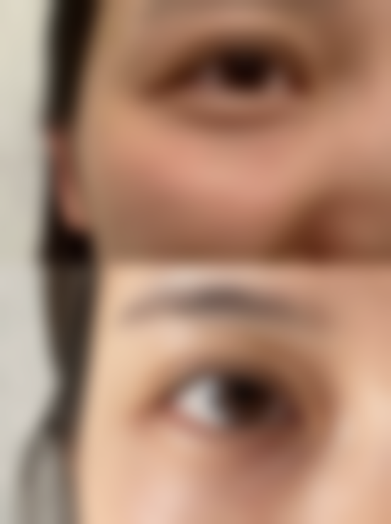 哪些人群在评估中更可能被建议考虑内双做双眼皮手术？