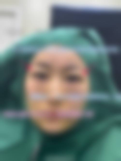 双眼皮伤疤增生手术切除的优势与风险