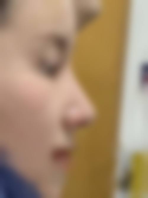 韩式隆鼻的独特精细技术体现在哪