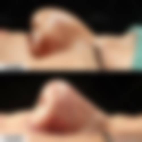 异体肋骨隆鼻常见并发症或后遗症，真实发生概率如何？