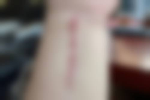 在决定是否选择双眼皮伤疤增生去除方法前，普通用户更容易忽略的关键评估点及医院医生推荐名单