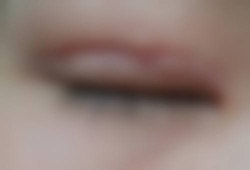 哪些人群在评估中更可能被建议考虑双眼皮伤疤增生去除方法？