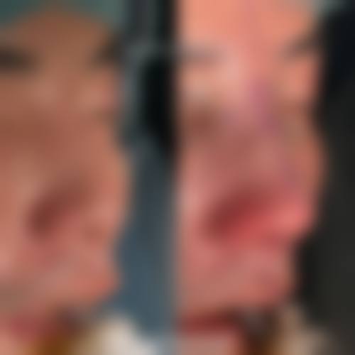 材料质量对异体肋骨隆鼻维持时间的影响