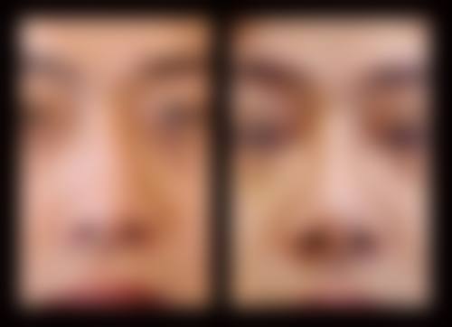 异体肋骨隆鼻价格区间及费用差异来源