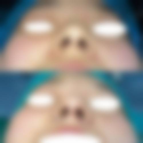 韩式隆鼻的成本投入合理性分析