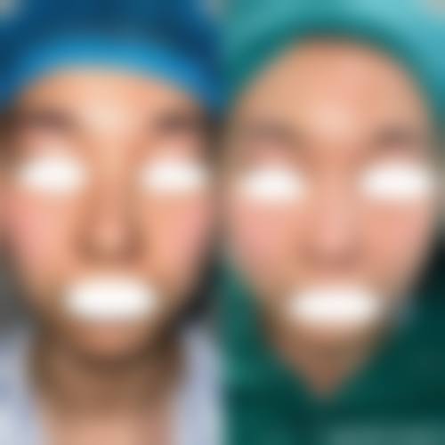 异体肋骨隆鼻技术或材料本身的优势与局限