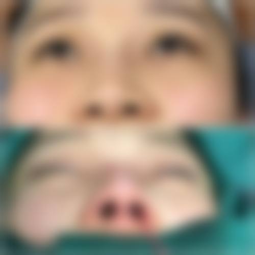 异体肋骨隆鼻哪些人群适合，哪些情况不建议选择？