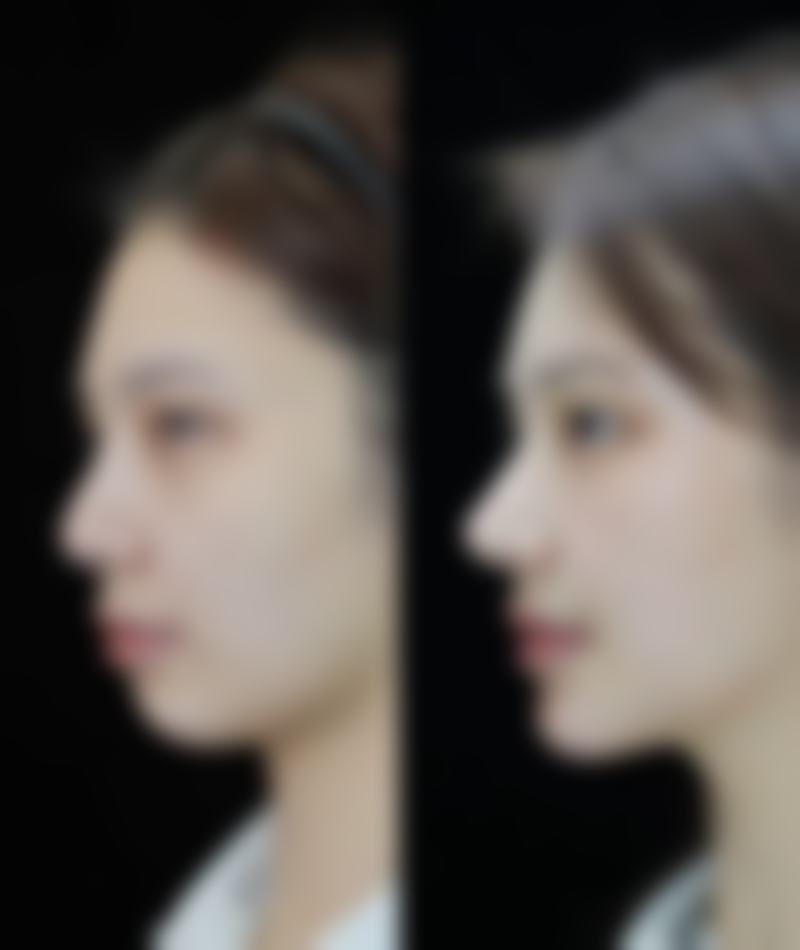 异体肋骨隆鼻手术成效能维持多久？