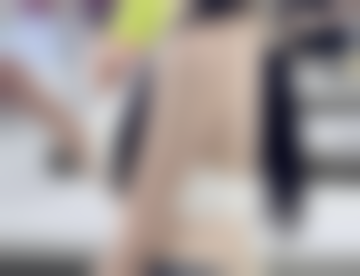 如何选择手术抽脂的医院和医生？