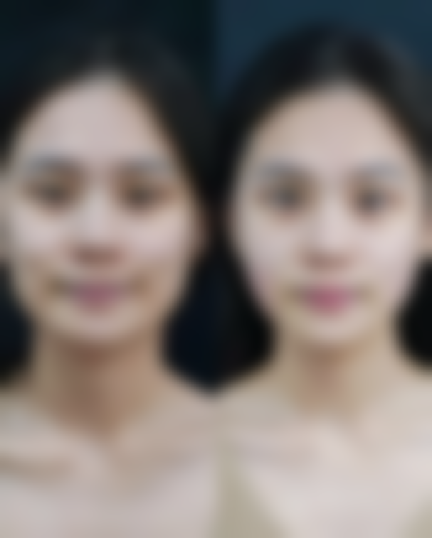 {异体肋骨隆鼻能保持多久？10-20年效果持久，医生技术+材料质量决定最终效果！