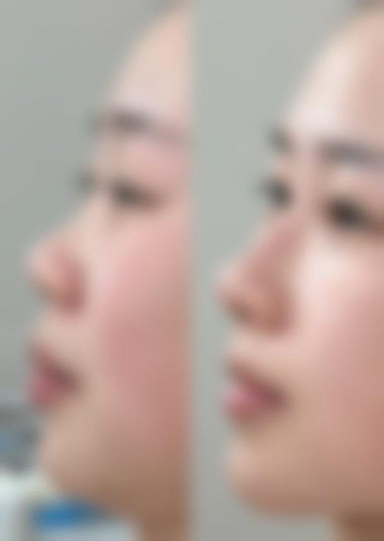 疤痕妊娠需要住院吗？当然需要！因其风险高，易致大出血等，住院能保障及时救治！一般住3-7天，费用几百至万元不等