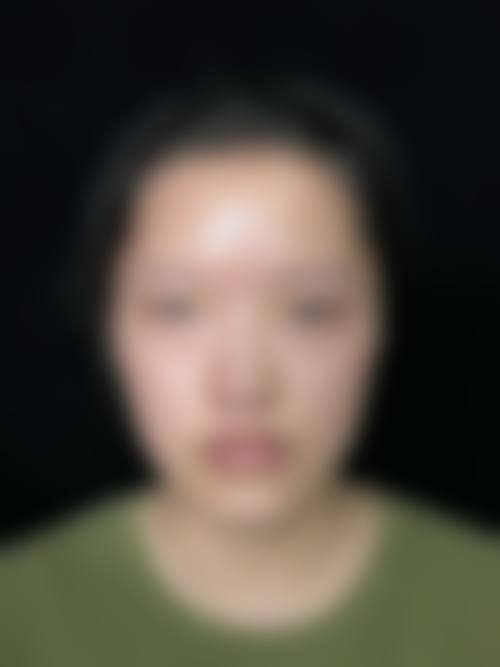 “之前做了埋线双眼皮,线没有抽出直接做了全切”：术后护理避坑指南