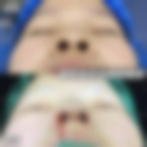 自体隆鼻哪些人群适合,哪些情况不建议选择?