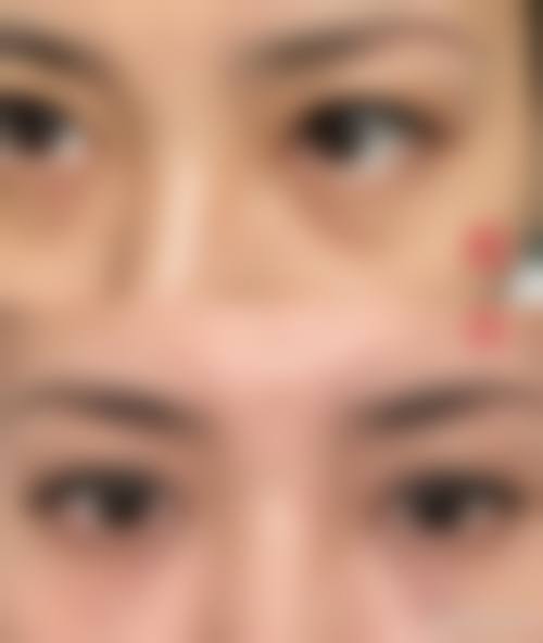 按摩改善眼袋黑眼圈泪沟的原理与方法