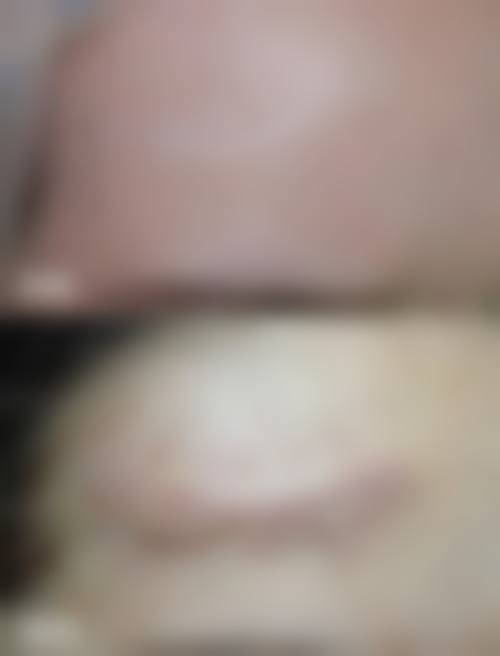 增生疤痕发红修复正常颜色治疗需要多久?