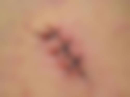 增生疤痕发红修复正常颜色治疗需要多少钱?