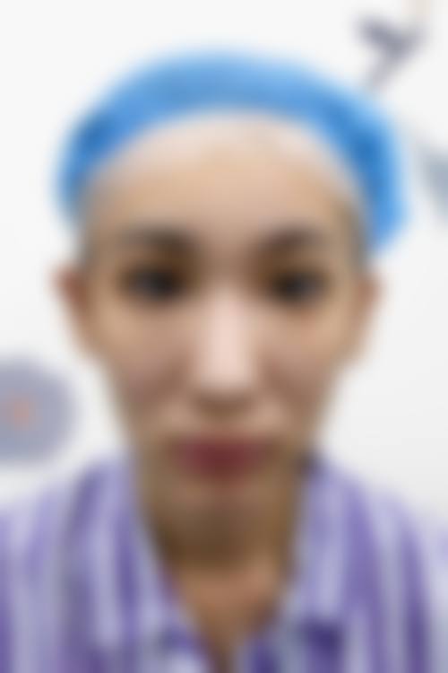 隆鼻哪种是恒久的？自体软骨隆鼻真实修复过程与不适时间线