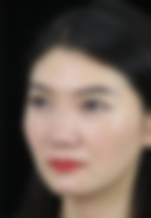 哪些人，自体软骨隆鼻风险显著更高