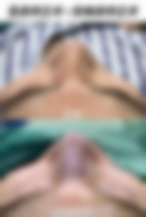 自体隆鼻技术或材料本身的优势与局限