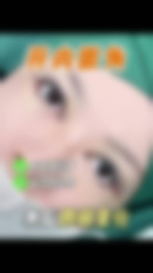 真人实例现身说法：“不拆线埋线双眼皮改全切”的真实成效